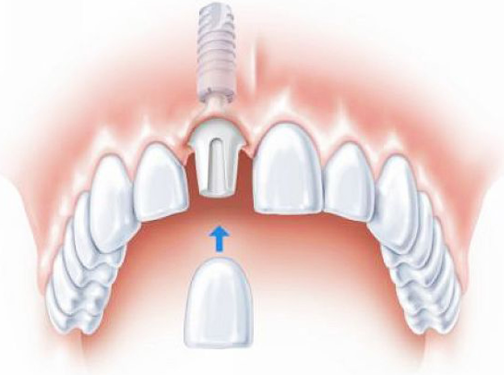 连云港江南口腔看牙靠谱吗?解析医生团队实力与种植牙技术优势!(图3)
