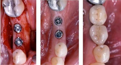 石家庄玉生口腔看牙收费价格表公开,韩系种植牙4800+牙齿矫正8800+都划算!(图1)