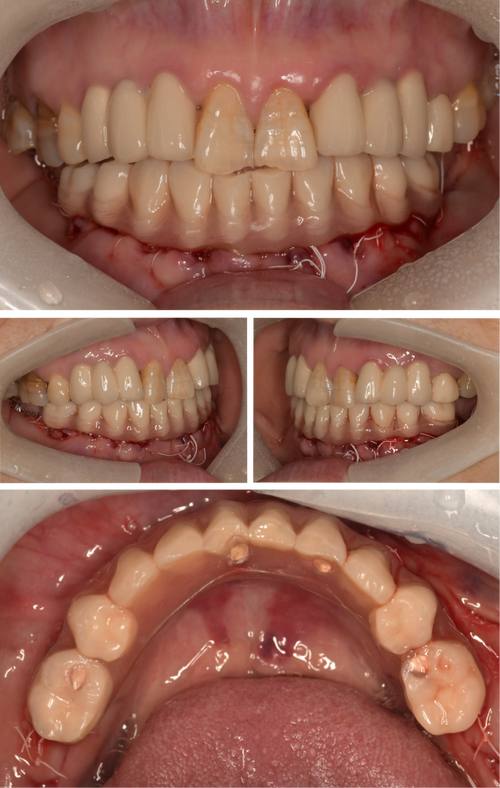 包头牙齿种植一颗价格多少钱?包头地区种植牙通常需要7370到19886元左右(图2)