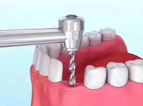 包头种植牙多少钱一颗2025价格表?种植牙7284-20126元+全瓷牙6700-20372元+隐形矫正11274-27249元(图3)