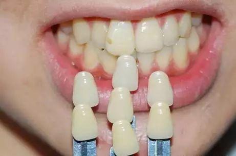 长沙美亚口腔医院种植牙技术有哪些优势?三大核心特色解析:精准种植、美学修复与个性化方案(图1)