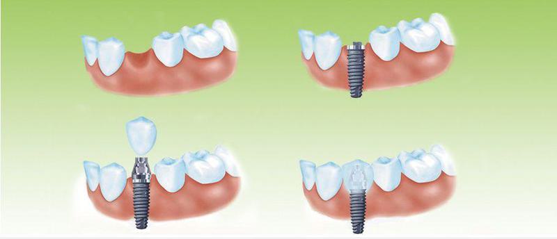 牙齿种植有年龄限制吗?淄博诺尔漫齿科解析种植牙适应人群与注意事项(图3)
