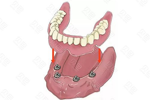 绍兴贝佳口腔·种植牙中心靠谱吗?正规资质+专业医生团队+先进设备解析