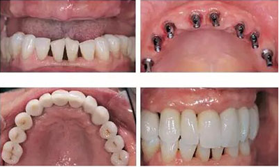 这份绵阳经开区种植牙价格表告诉你牙齿种植多少钱一颗才合理(图4)