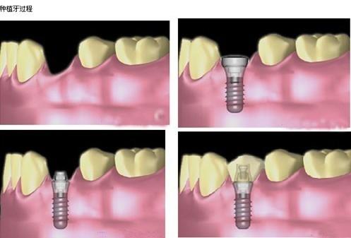 盘锦种植牙医院哪家技术好?精选5家专业牙科机构实力对比!(图2)