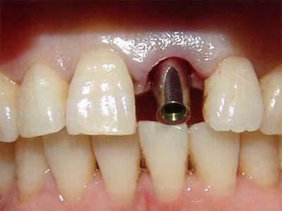 三亚市种植牙哪家好?三亚市种植牙好的医院有三亚口腔医院、三亚微笑牙科(图1)