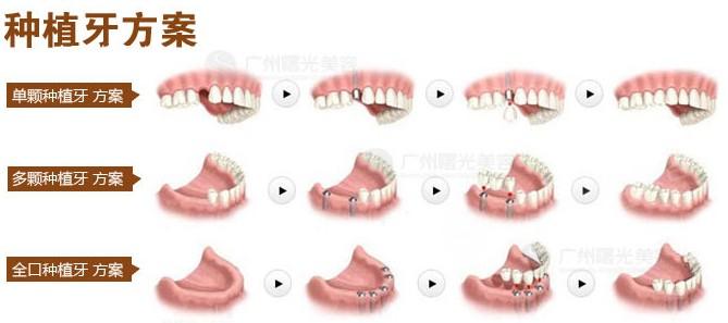 中山石岐口腔医院牙齿种植价格表2025版,种植牙费用和材料选择指南(图2)