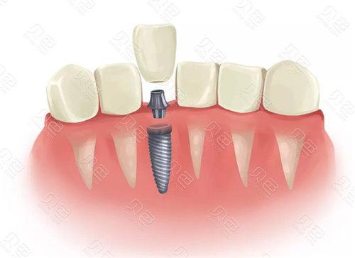 想在昆明做种植牙手术?这五家专业口腔医院收费透明位置便利!(图1)